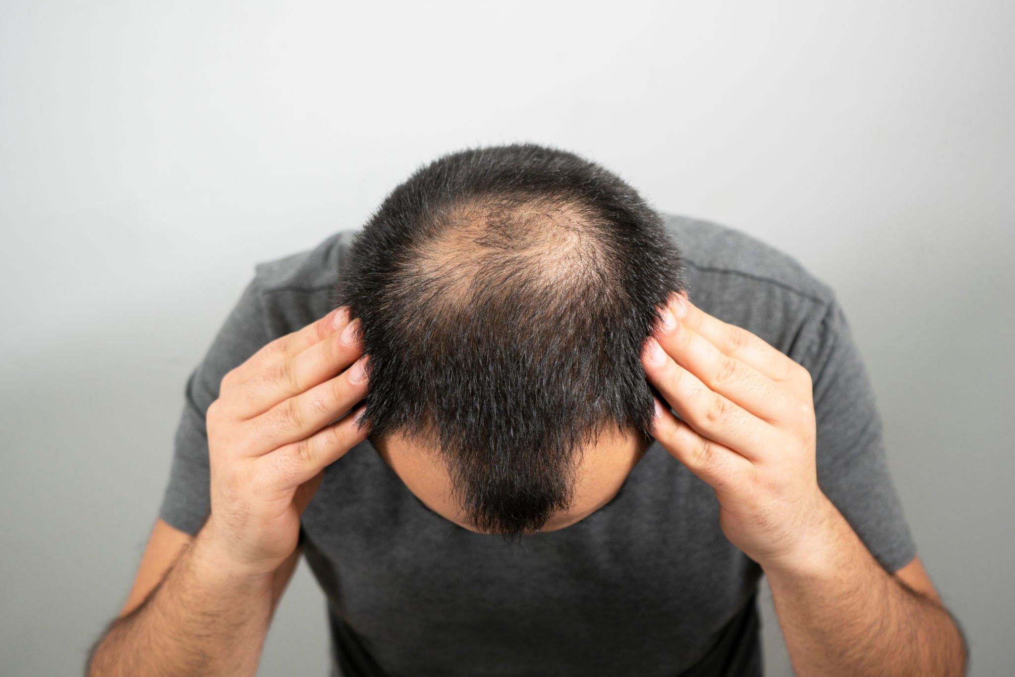 Types of hair loss There are five main types of hair loss: