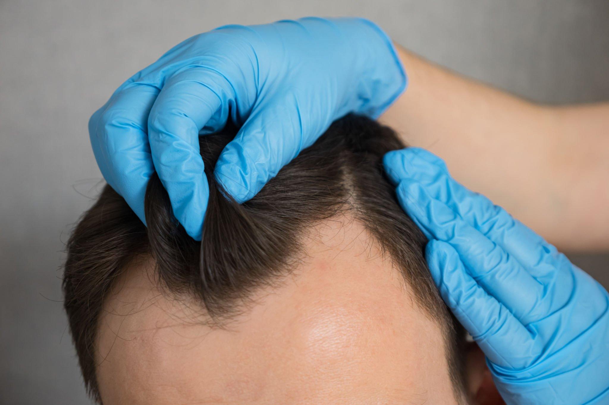 Crucial Steps for Hair Transplantation at Dermijan: