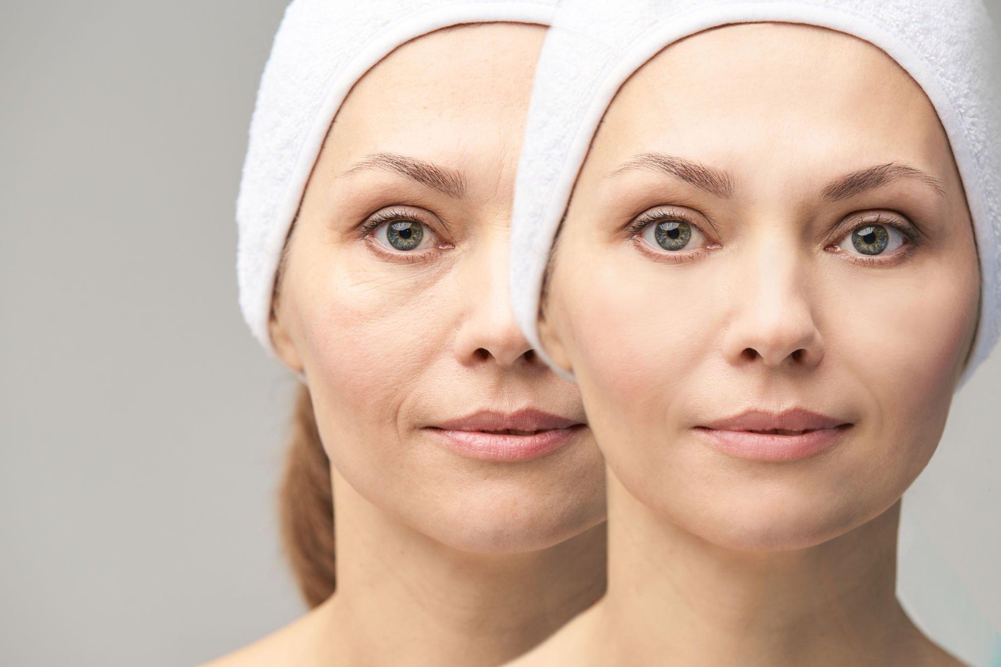Types of Wrinkle Fillers and Treatments: