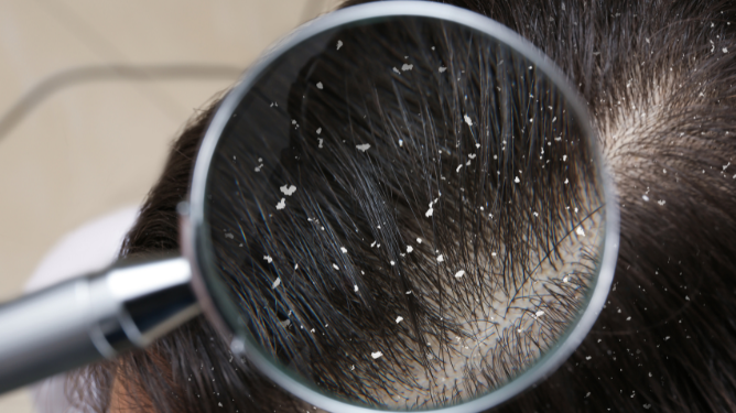 Treating dandruff and acne