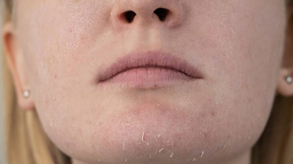 Problem Dry, Flaky Skin​